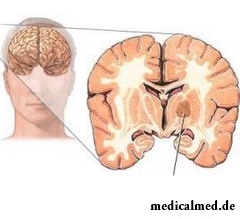 Глиобластома – опухоль головного мозга