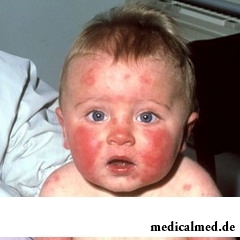 Инфекционная эритема у детей может вызывать различные осложнения