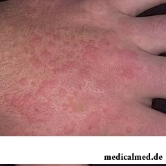 Инфекционная эритема на руке