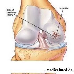Инфекционный артрит – сложное инфекционное заболевание суставов