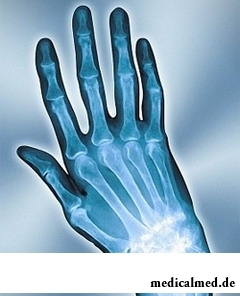 Инфекционный артрит поражает кисти рук