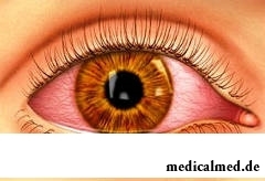 Комбинил применяется при инфекционно-воспалительных заболеваниях глаза и его придатков