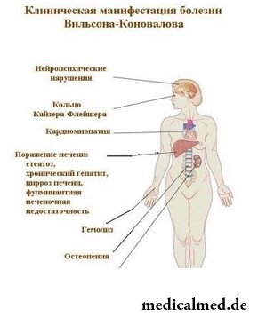 Клиническая манифестация болезни Вильсона-Коновалова