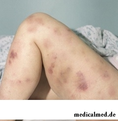 Бледность кожных покровов - один из симптомов лимфолейкоза
