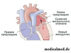 Митральный стеноз - приобретенный порок сердца
