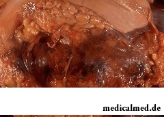 Панкреонекроз - тяжелое заболевание поджелудочной железы