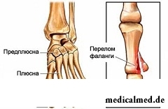 Диагностика перелома пальца ноги