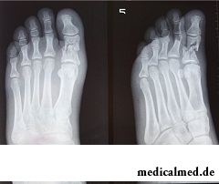 Более точную информацию о переломе пальца ноги может показать рентген
