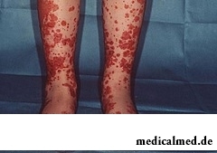 Пурпура - наличие на коже мелких капиллярных кровоизлияний