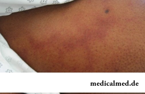 Симптомы стронгилоидоза под кожей