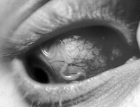 Глаз человека при заболевании таскорозом