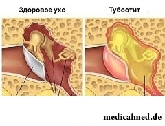 Тубоотит - воспаление слизистой оболочки внутреннего уха