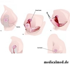 Принцип операции по уменьшению груди