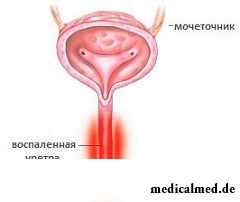 Уретрит - воспаление мочеиспускательного канала (уретры)